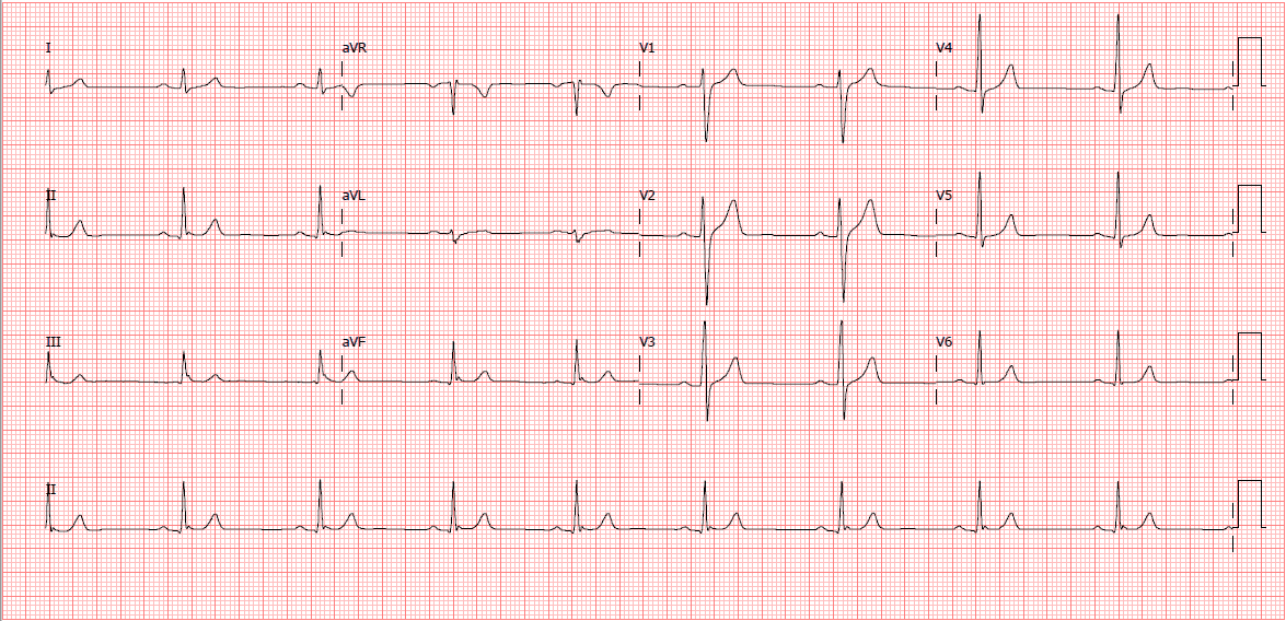 Eletrocardiograma normal Masculino 32 anos