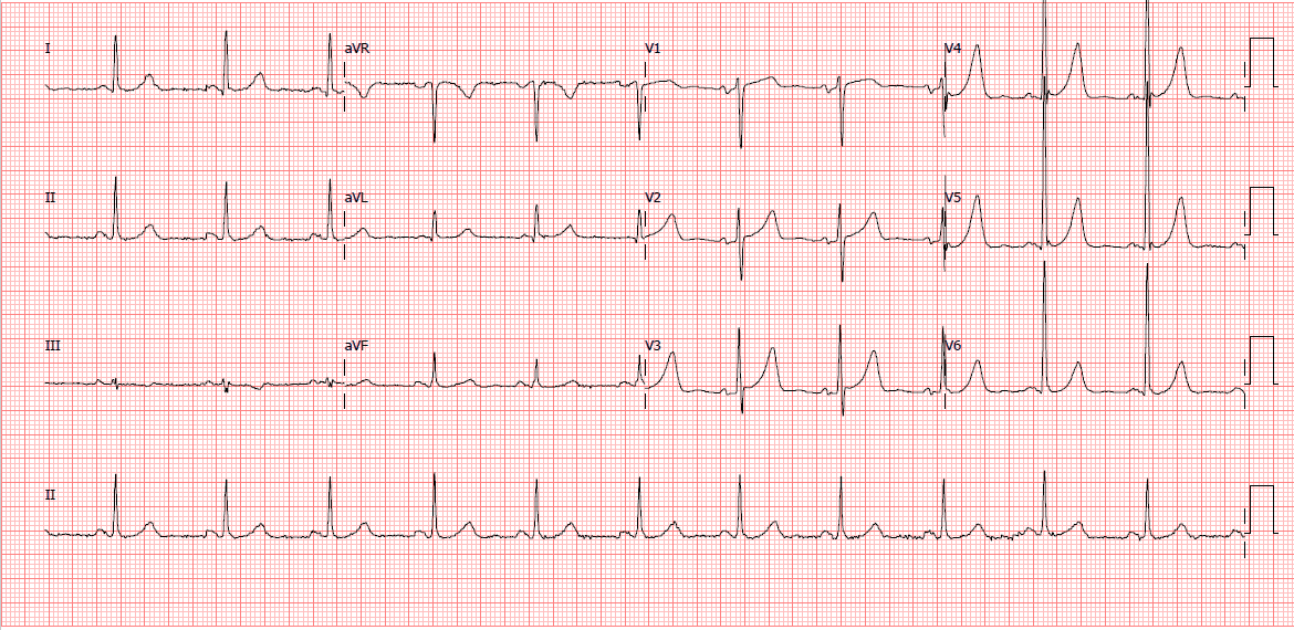 Eletrocardiograma - Sobrecarga Ventricular Esquerda.PNG