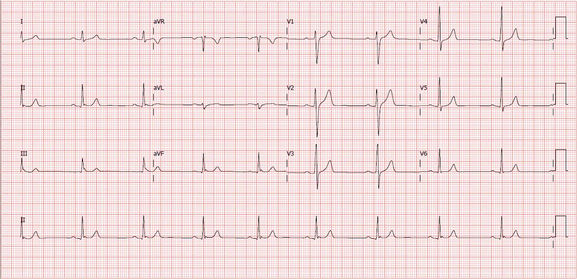Eletrocardiograma normal - Masculino 32 anos