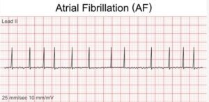 Eletrocardiograma de Fibrilação Atrial - Arritmia cardíaca