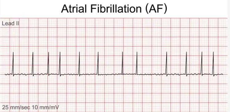 Eletrocardiograma de Fibrilação Atrial - Arritmia cardíaca