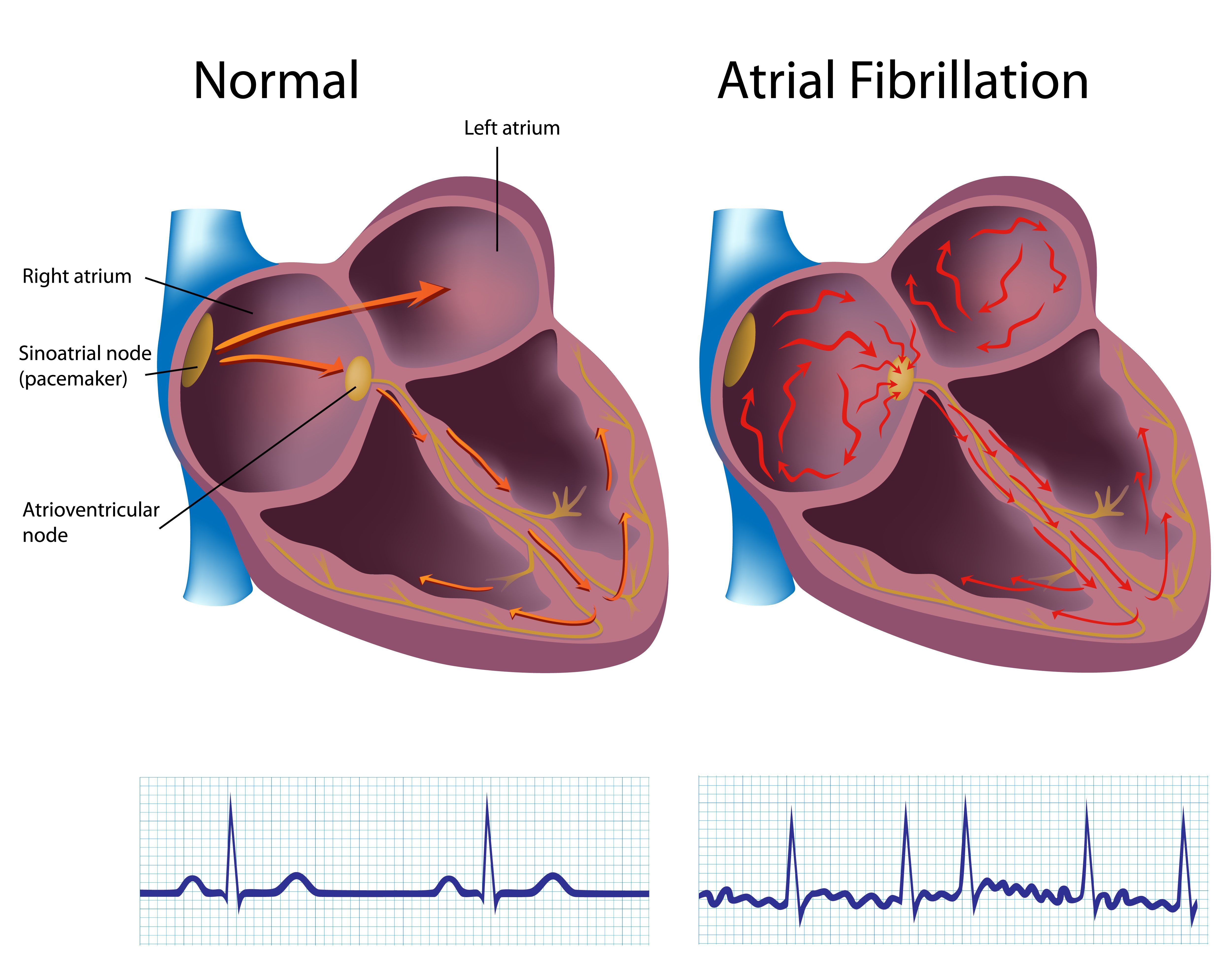 Fibrilação atrial - Imagem de um coração com fibrilação atrial e ECG com FA