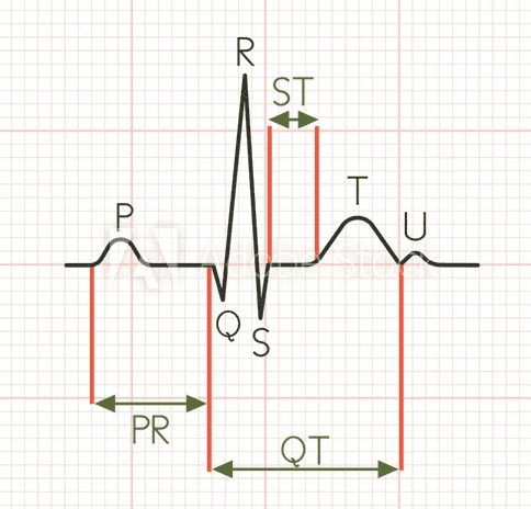 Eletrocardiograma - intervalo QT.PNG