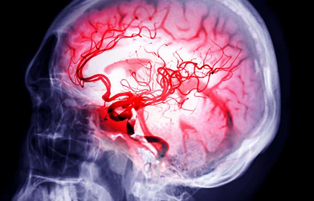 como prevenir um AVC. Imagem de artérias cerebrais.