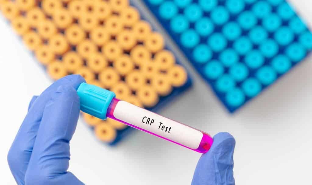 Qual exame mostra seu risco cardiovascular? Proteina C Reativa Ultrassensível. Nesta imagem, temos um tubo com o escrito em inglês CRP teste, ou seja, um teste para detectar a PCR no sangue, também conhecida como Proteina C Reativa.