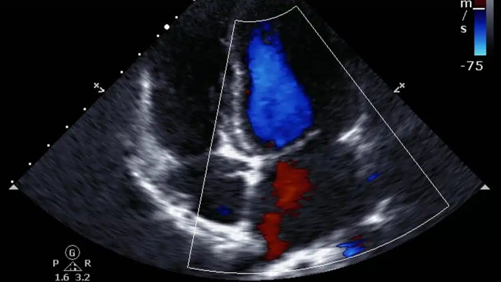 imagem de um exame de ecocardiograma para identeificar causa e tipos de sopro cardíaco 