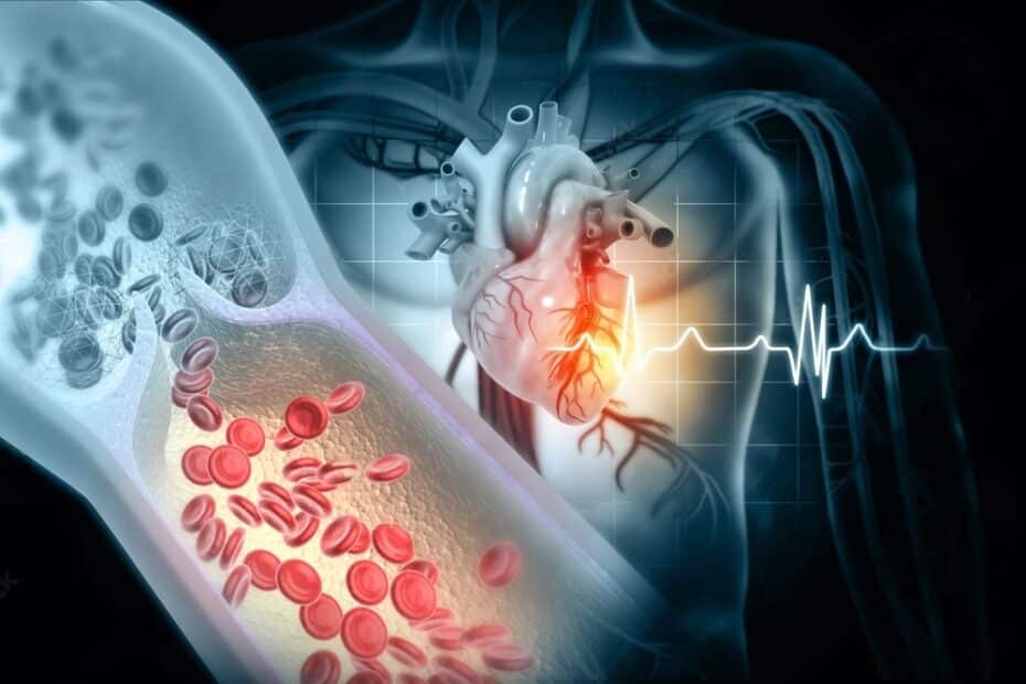 Isquemia miocárdica - aterosclerose - dor no peito - infarto