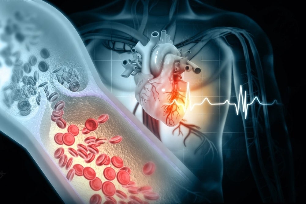 Isquemia miocárdica - aterosclerose - dor no peito - infarto