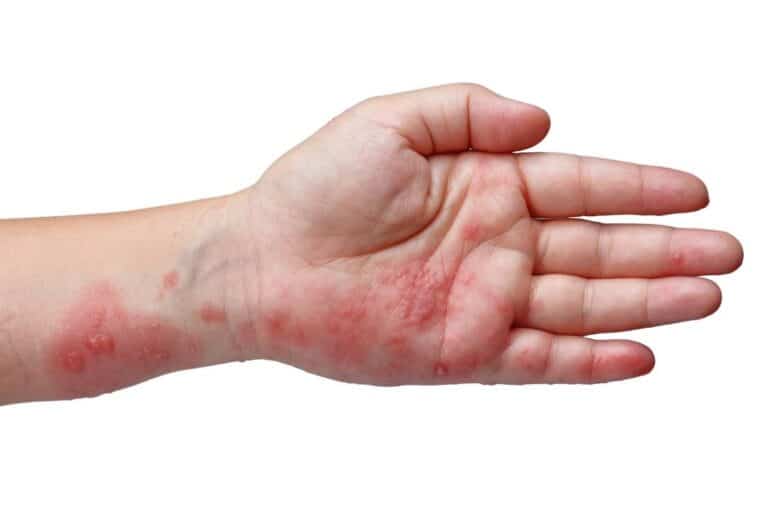 Herpes Zoster: O que é, sintomas e tratamento 4 mão estendida com herpes zoster