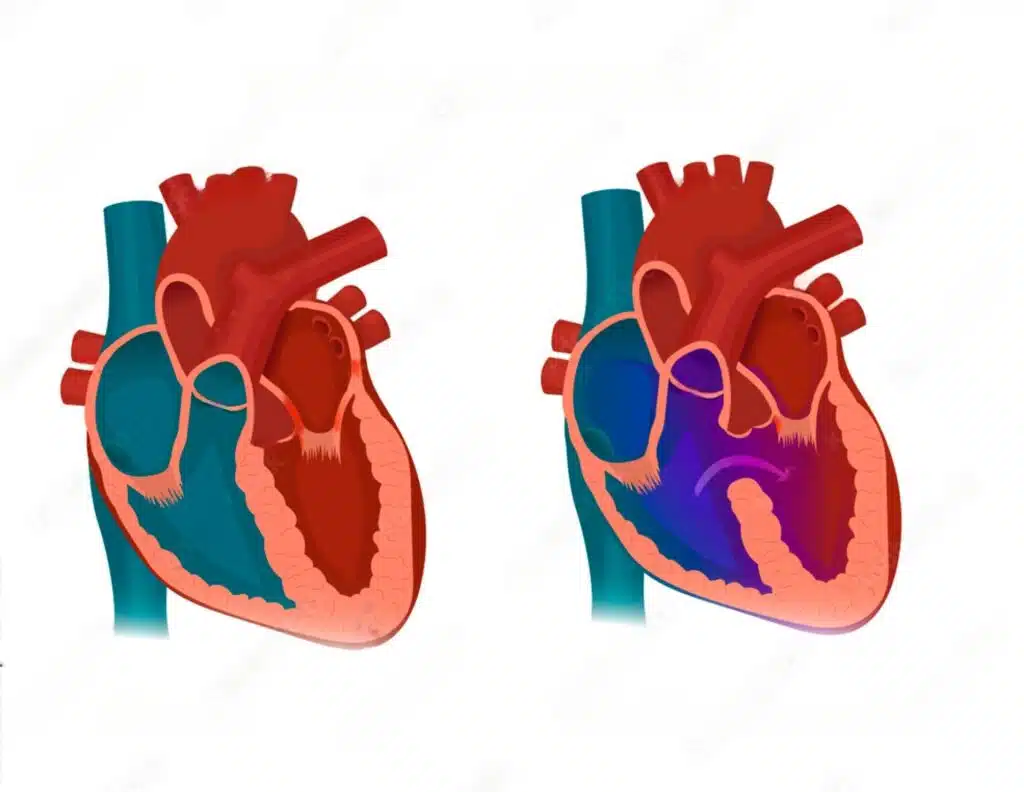 No canto esquerdo um coração normal e a direita um coração com CIV - seta mostrando defeito do septo ventricular levando a uma comunicação interventricular