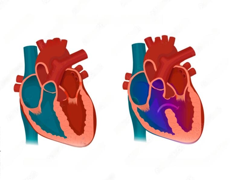 Comunicação Interventricular (CIV): Um olhar sobre esse defeito Cardíaco Congênito 3 No canto esquerdo um coração normal e a direita um coração com CIV - seta mostrando defeito do septo ventricular levando a uma comunicação interventricular