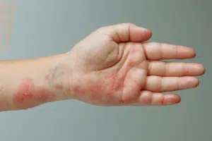 Pessoa com a mão estendida mostrando os ferimentos causados pela Herpes Zoster