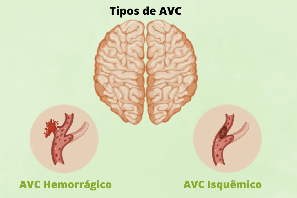 Imagem com um cérebro e duas representações do AVC - o hemorrágico e o isquêmico