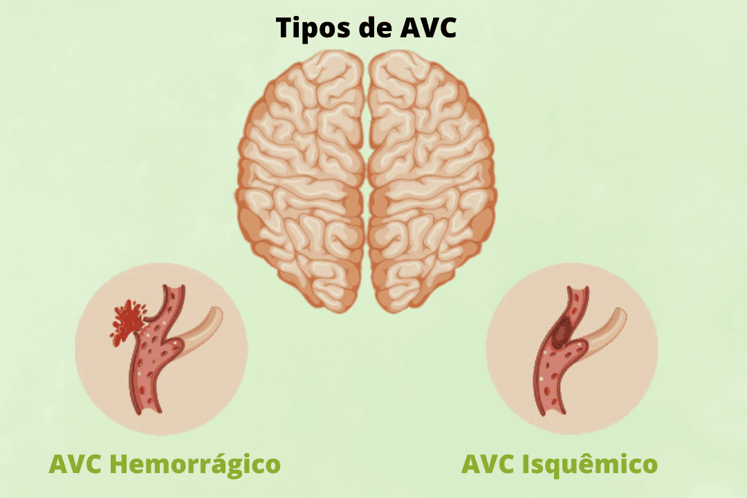 O Que é O AVC E Como Prevenir Um Acidente Vascular Cerebral