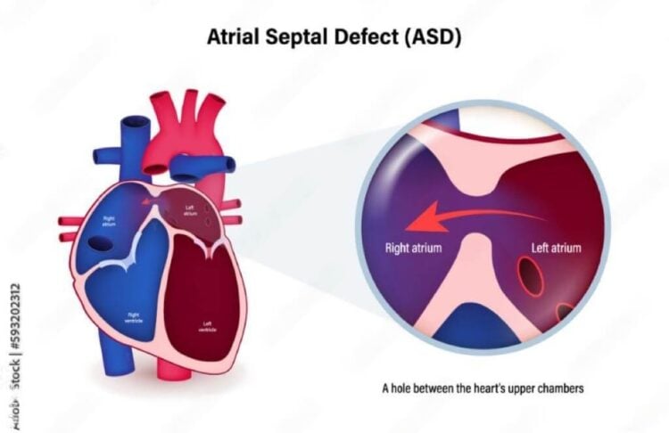 Imagem ilustrativa de um coração com defeito do septo atrial: Comunicação Interatrial