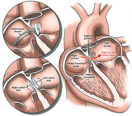 Imagem figurada e explicativa sobre a condição de Forame Oval Patente no corpo humano