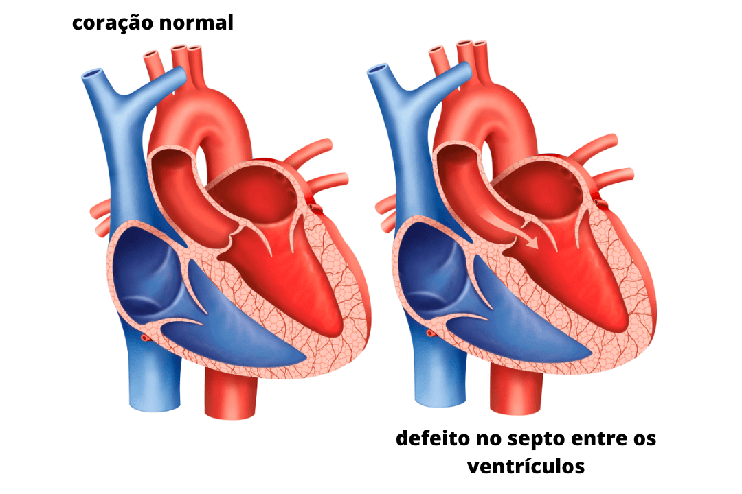 imagem ilustrativa de dois corações, um possui um defeito no septo entre ventrículos e o outro é normal.