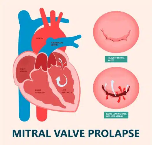 Desenho ilustrativo de um coração mostrando fluxo sanguíneo: à esquerda, válvula mitral fechada em estado normal e, à direita, prolapso da válvula mitral resultando em insuficiência valvar