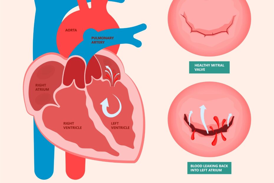 Desenho ilustrativo de um coração mostrando fluxo sanguíneo: à esquerda, válvula mitral fechada em estado normal e, à direita, prolapso da válvula mitral resultando em insuficiência valvar