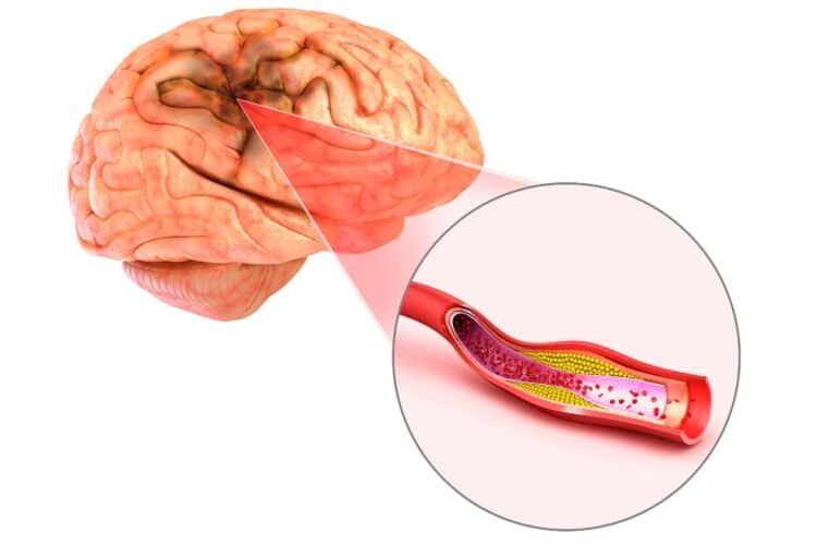 Imagem ilustrando o bloqueio de um vaso sanguíneo no cérebro, levando a um AVC