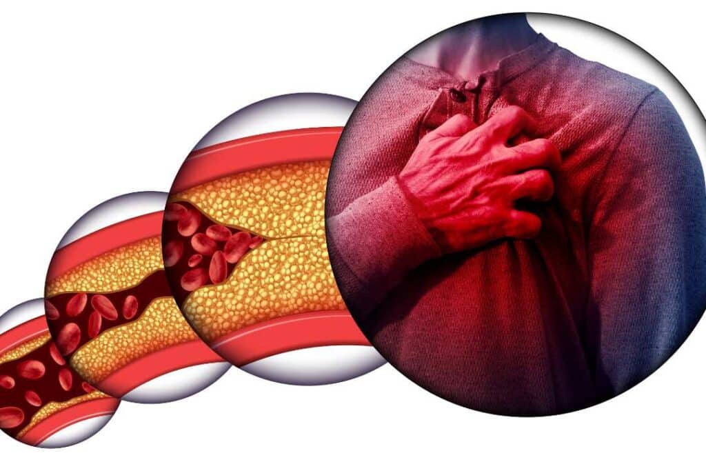 Diagrama simples mostrando o fluxo de sangue no coração e um bloqueio em uma artéria