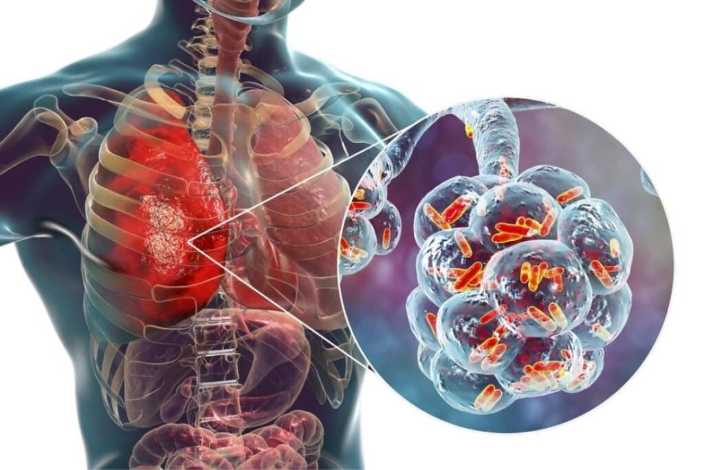 corpo humano representando uma pneumonia instalada no pulmão