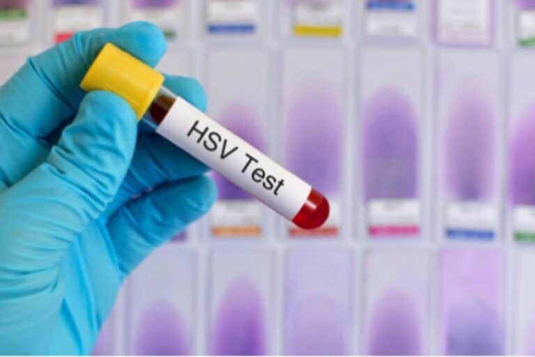 Herpes Simples: O que é, sintomas e tratamento 9 enfermeiro segurando uma coleta de sangue de herpes