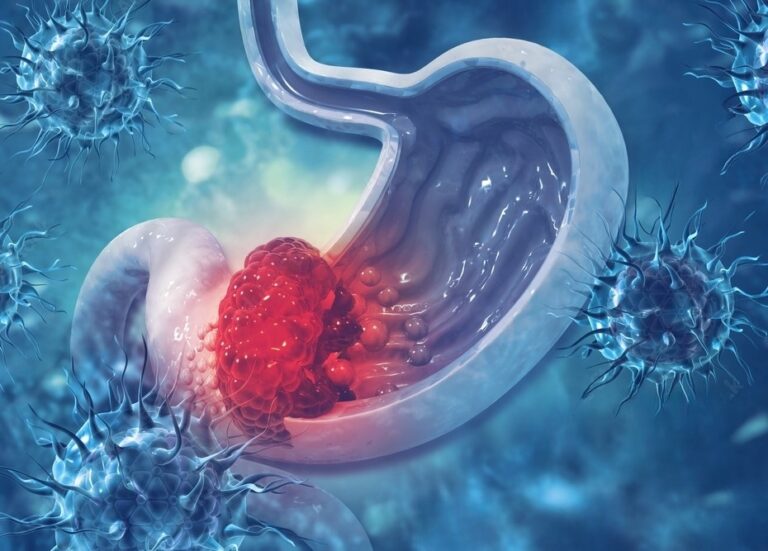 7 Anti-inflamatórios Comuns que podem levar a Hemorragia Digestiva 4 imagem representando úlcera no estômago