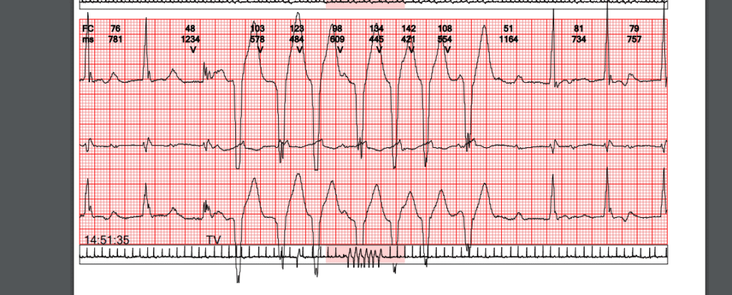 Holter 24horas Laudo 04 Taquicardia Ventricular Nao Sustentada