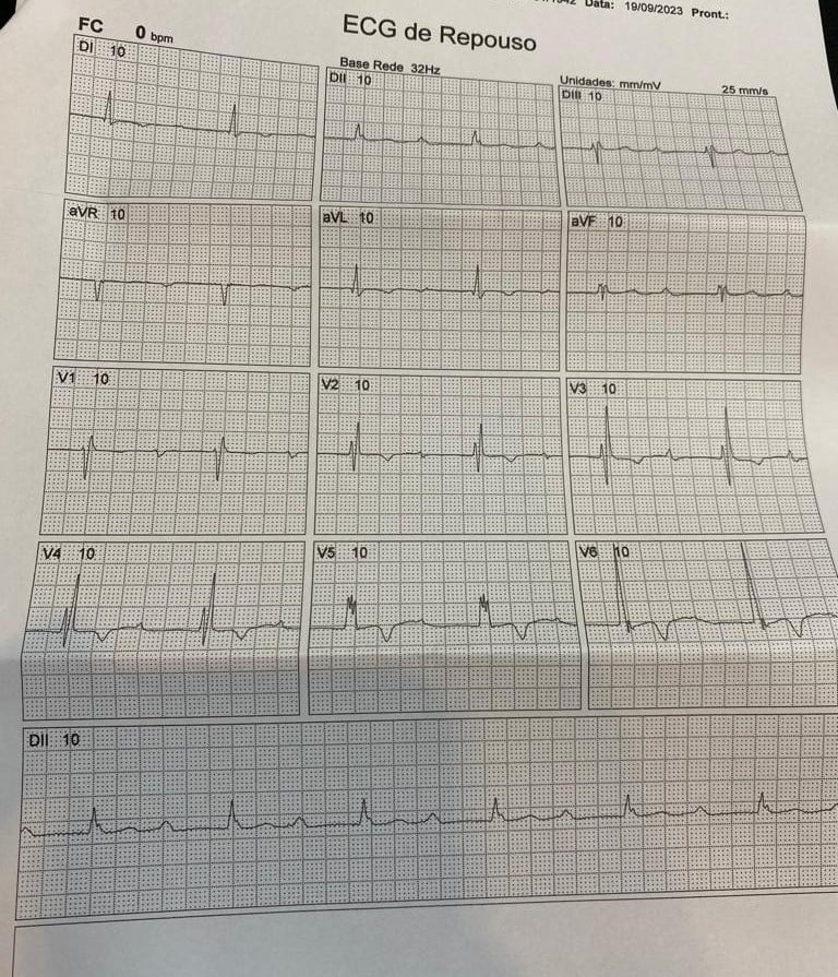 Eletrocardiograma evidenciando múltiplas anormalidades cardíacas, incluindo Bloqueio de Ramo Direito e Bradicardia Sinusal.
