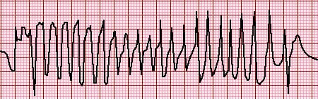 Imagem mostrando uma representação gráfica de um eletrocardiograma (ECG) com um padrão atípico de taquicardia ventricular. As linhas do ECG são irregulares e variáveis, demonstrando um eixo em constante mudança e morfologias QRS polimórficas, refletindo a natureza instável e bizarra da condição